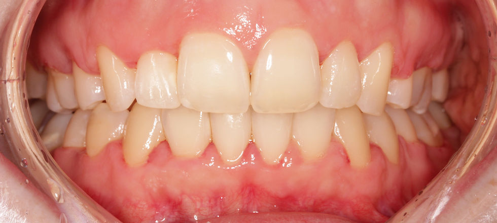 fogszabályozás kecskemét utána 4 dr szabó georgina (1).jpg