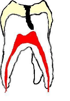 Trou dans la dentine d'une dent