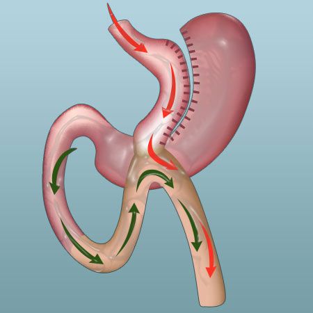 Bypass gastrique en Tunisie : technique, tarifs et séjour all-inclusive