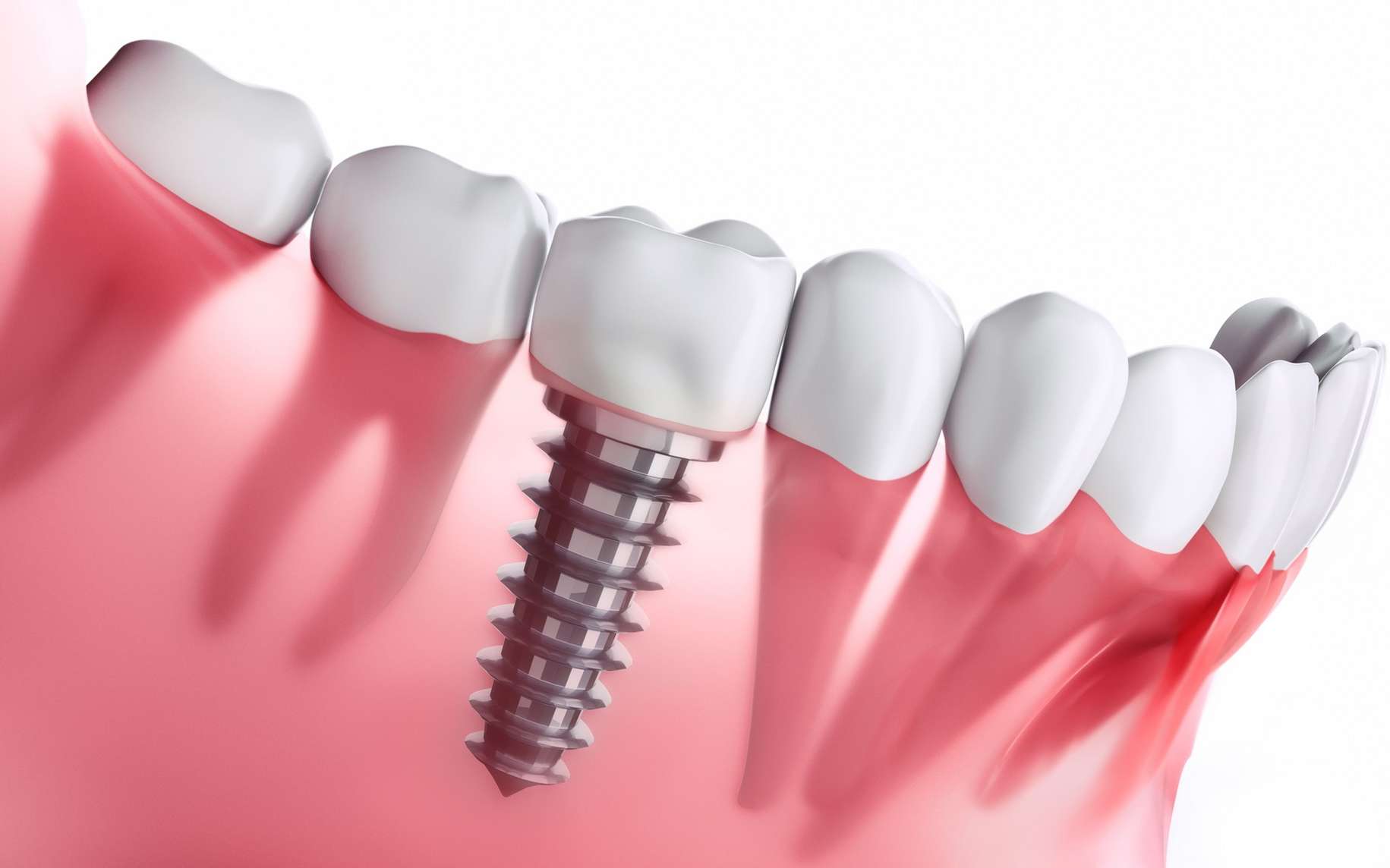 Implants dentaires en Tunisie : techniques, tarifs et séjour tout-compris