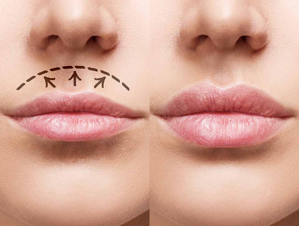 Lip lift en Tunisie : techniques, déroulement et séjour tout-compris