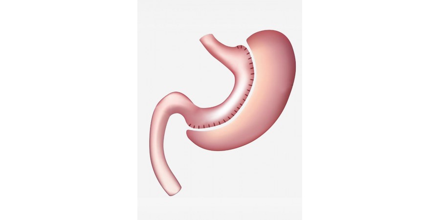 Sleeve gastrectomie en Tunisie : technique, tarifs et séjour tout-compris à Tunis