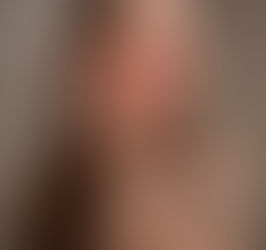 Lúpus: O que é e como a nutrição faz a diferença?