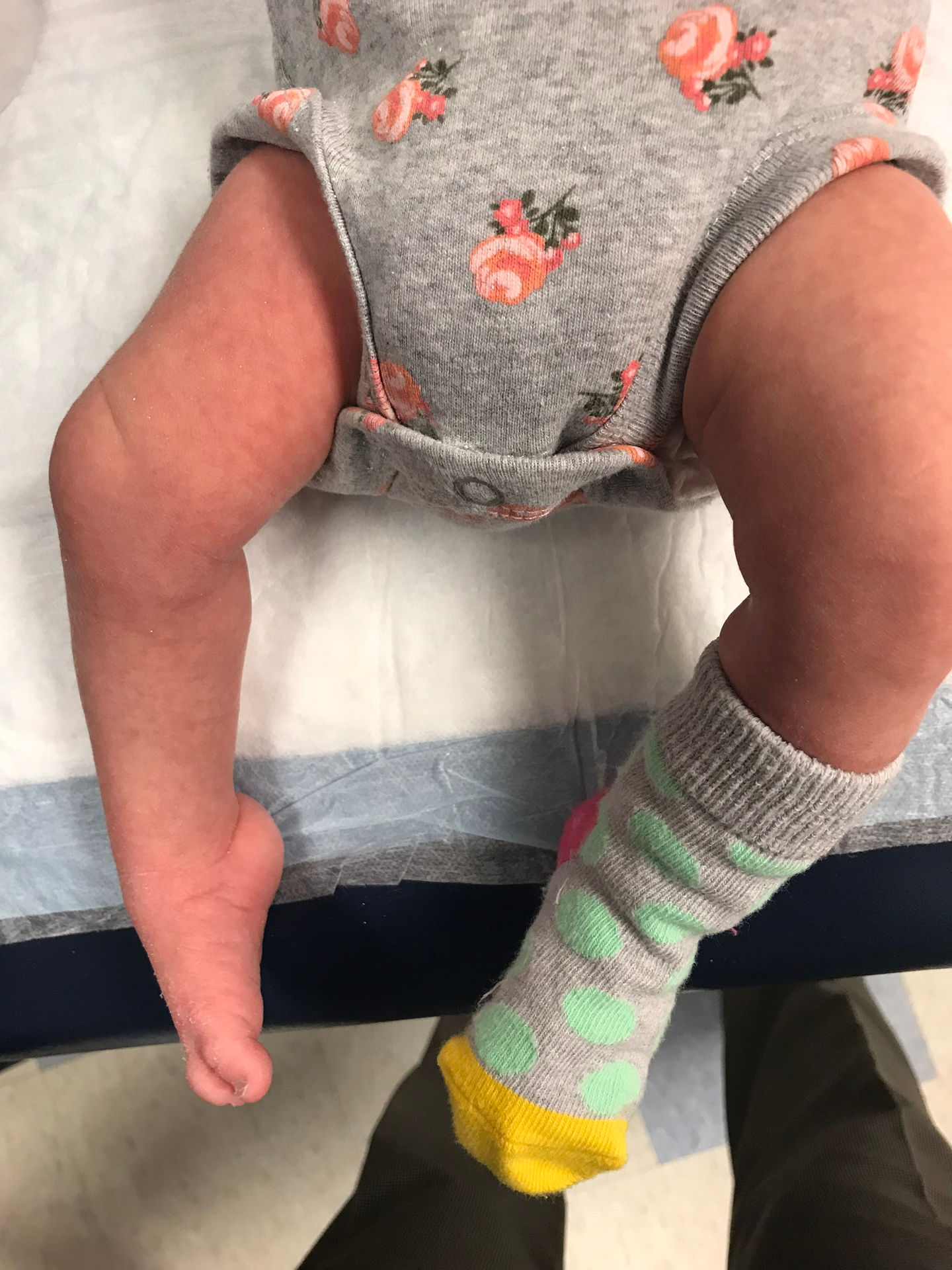 Immediately after first clubfoot cast came off
