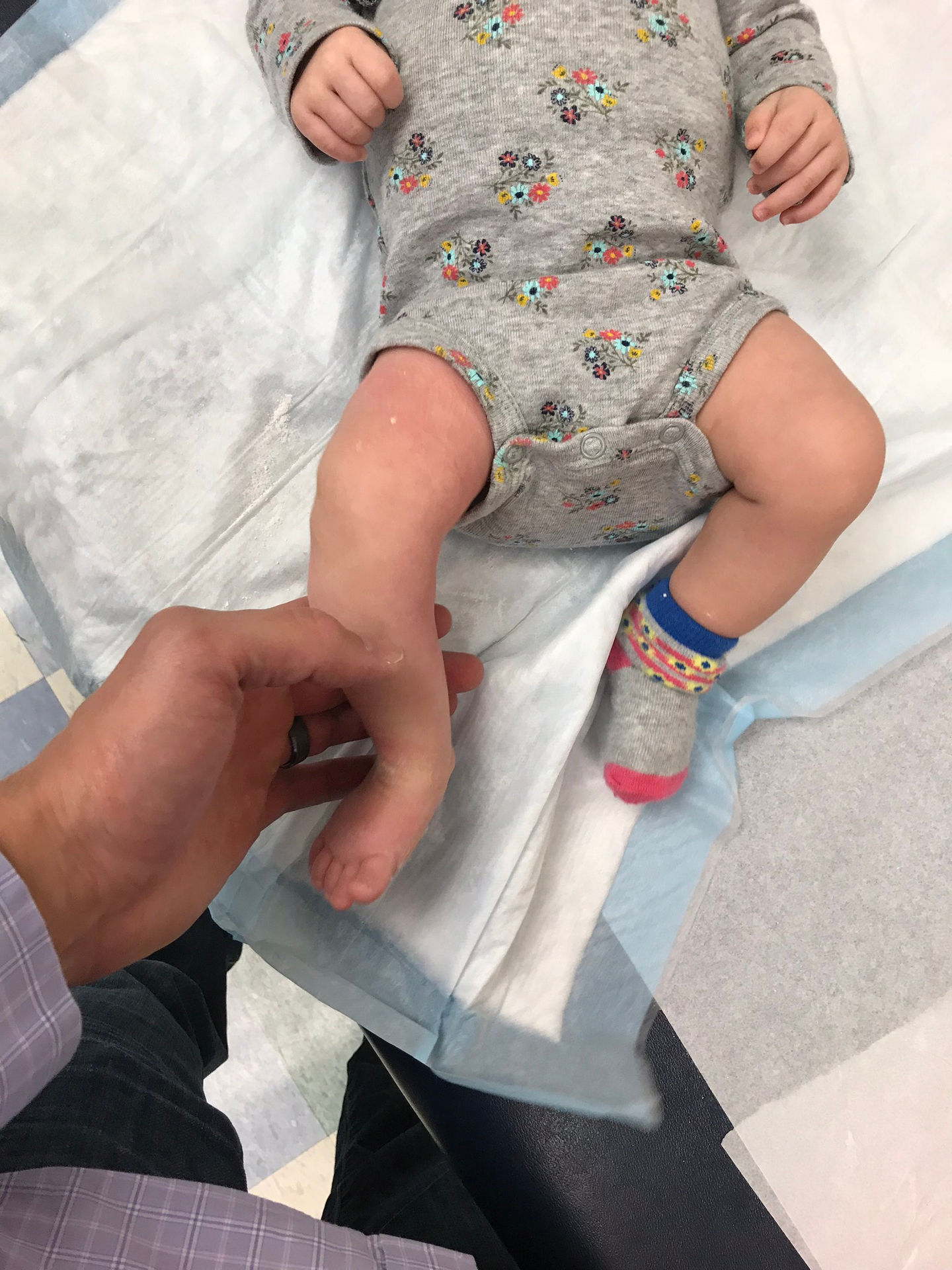 Baby having cast removed for clubfoot correction