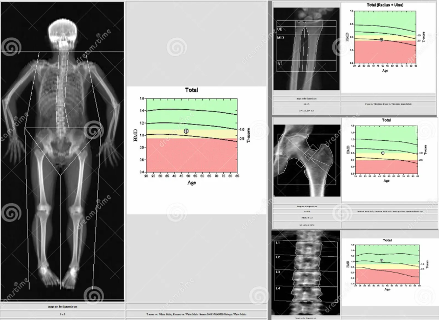 Don't Forget about the Bones!
