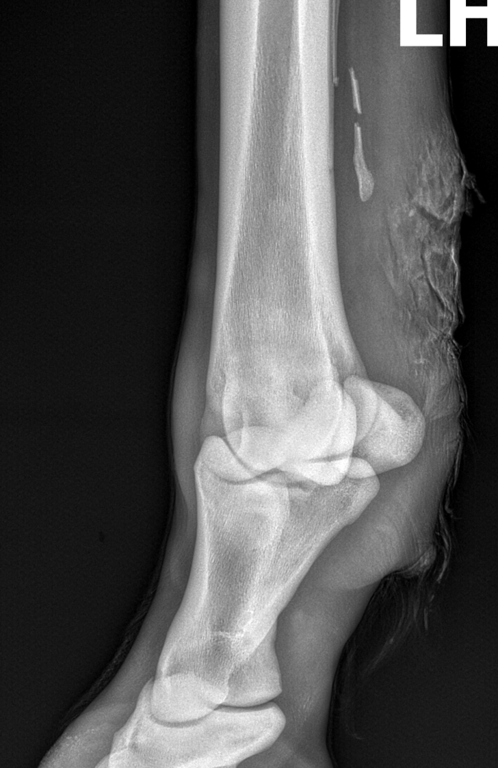 X-ray of a human lower leg focusing on the ankle joint. White skeletal structure on a dark background; visible "L" and "R" text.