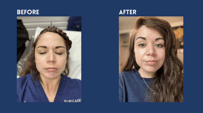 Aquagold before and after