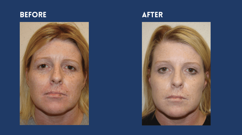 Aquagold before and after