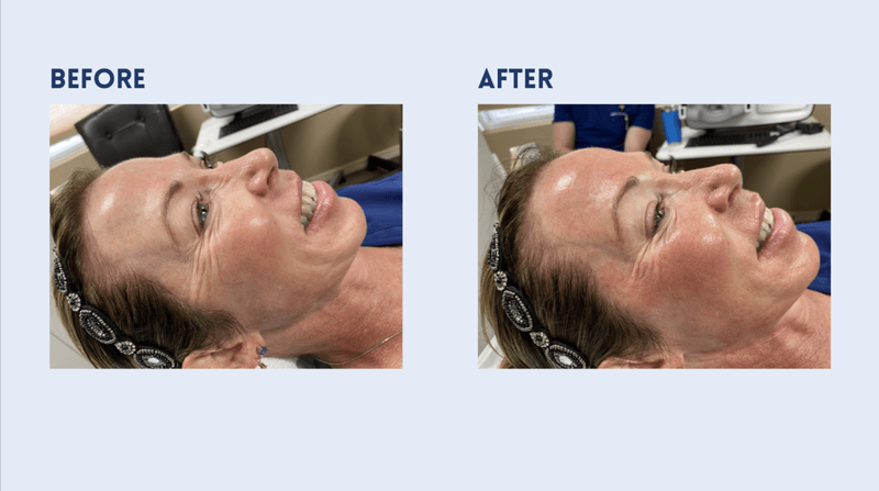 Aquagold before and after