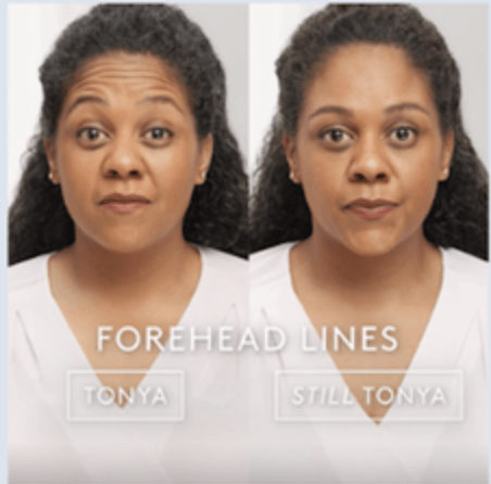 Botox Before and After