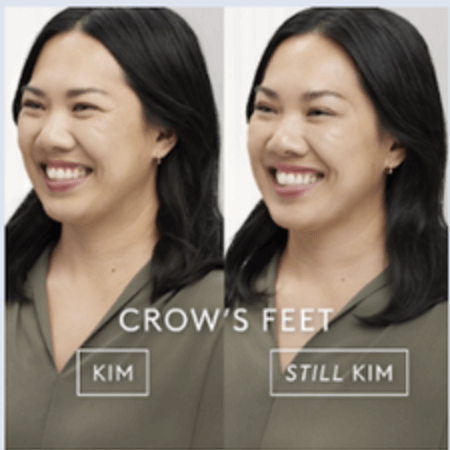 Botox Before and After