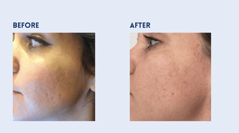 Aquagold before and after