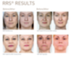 Mesotherapy results at Dr Kim Booysen Aesthetics