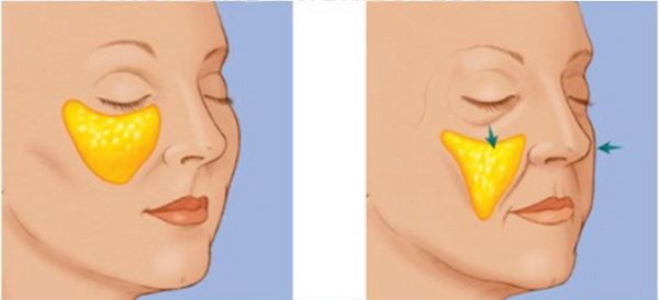 Midface fillers available from Dr Kim Booysen in Bromley and Beckenham at Dr Kim Booysen Aesthetic Treatments