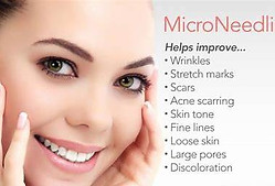 microneedling_edited.jpg