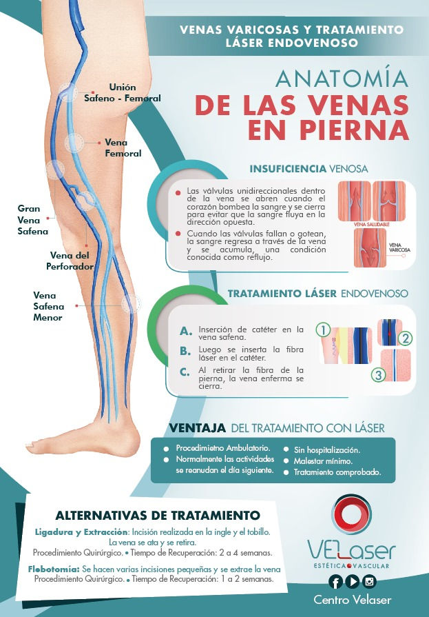 Venas y várices, insuficiencia venosa, válvulas venosas