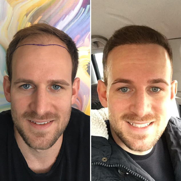 Sven from Germany, 3500 hair grafts