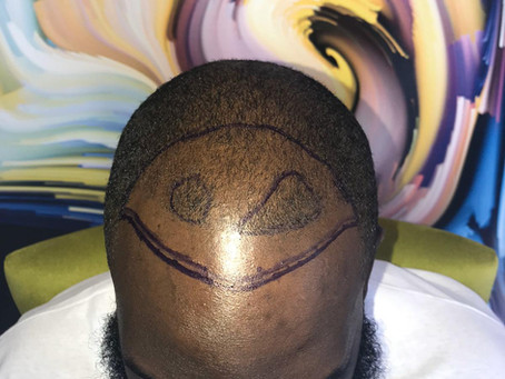 Hair Transplant for African People