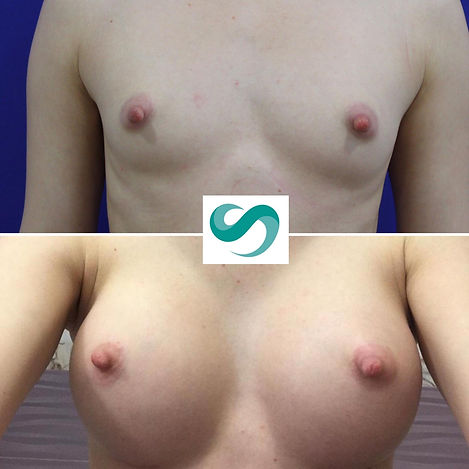 Breast Augmentation with implants