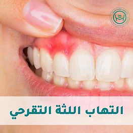 التهاب اللثة التقرحي