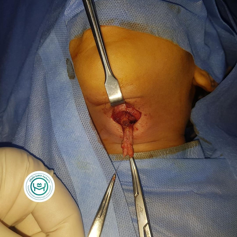 أثناء استئصال حويصلة درقية لطفل