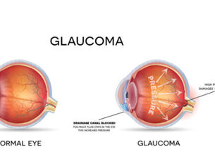 Preventing Invisible Vision Loss: Early Detection Strategies for Glaucoma