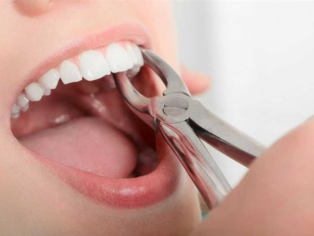 tooth removal in dubai