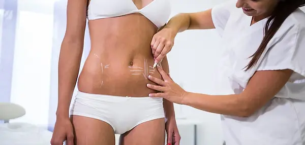 surgeon-drawing-lines-womans-abdomen-liposuction-cellulite-removal_107420-74081.webp