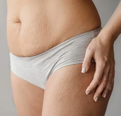 close-up-woman-body-with-stretch-marks_23-2148889277.webp