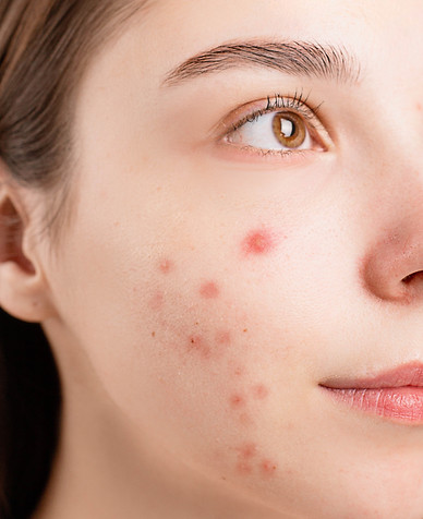acne 1.jpeg