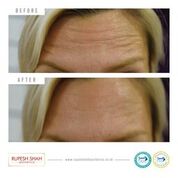 before and after botox
