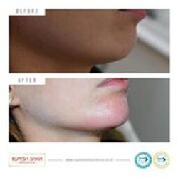 Before and After Chin Fillers
