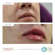 lip fillers before and after 1ml