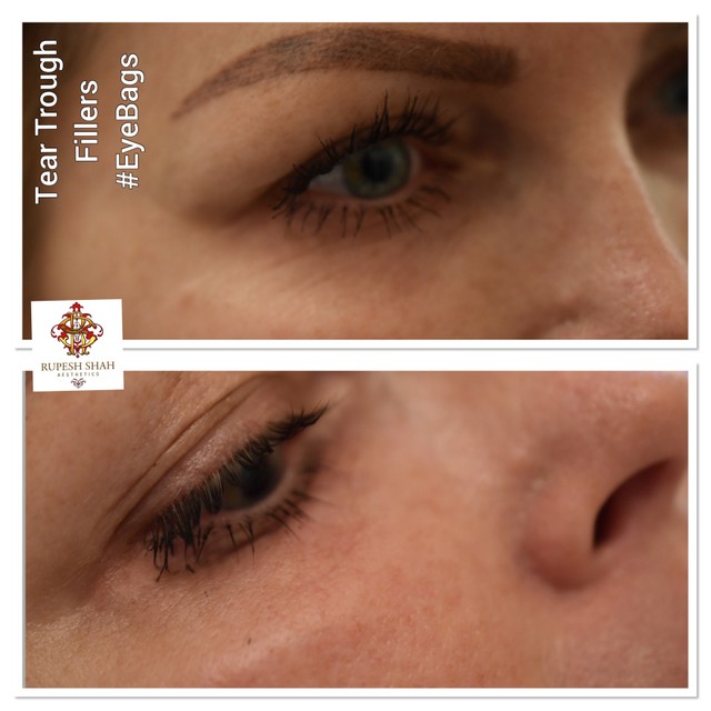 tear trough filler before and after