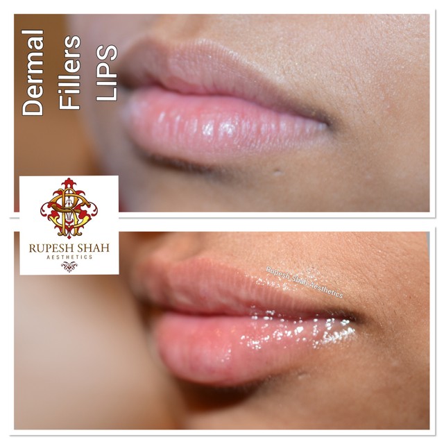 lip fillers before and after 1ml