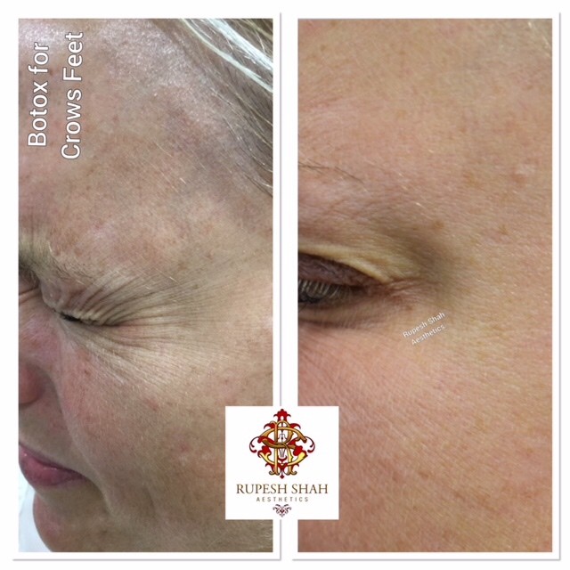 before and after botox