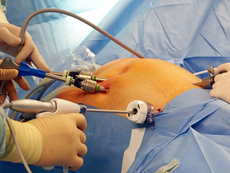 Gallbladder Stone Operation