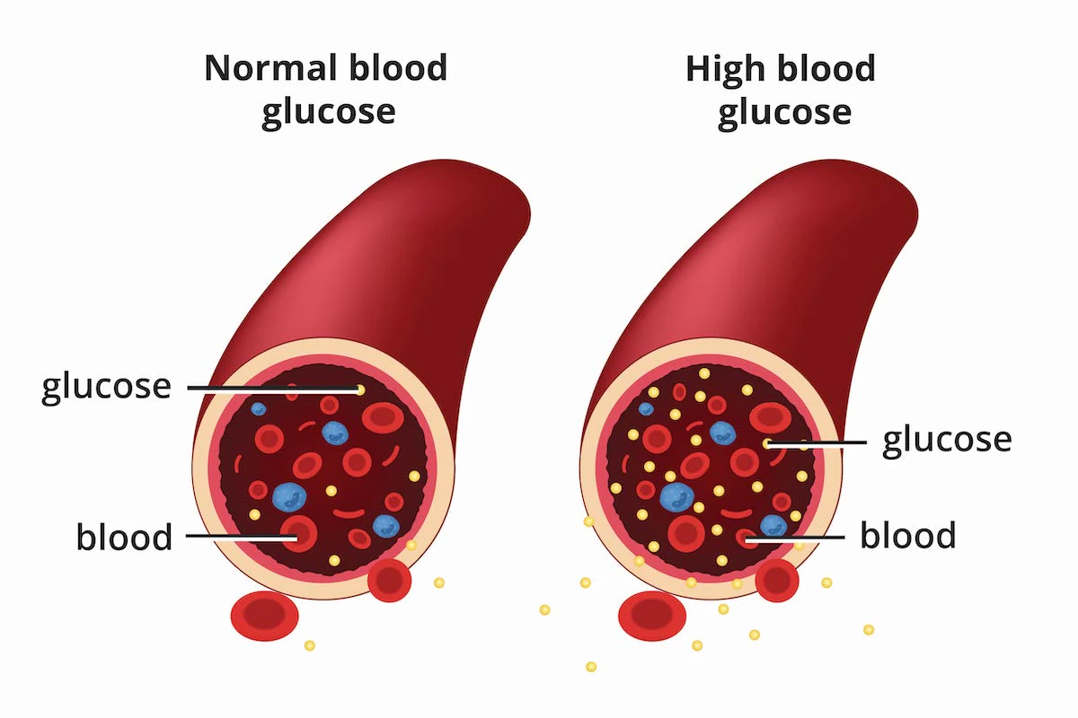 BloodGlucoseImage2Feb231200x800.jpg.webp