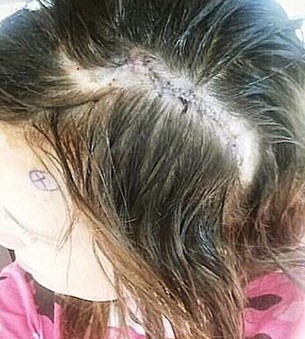 Hydrocephalus Awareness Courtney Sanders
