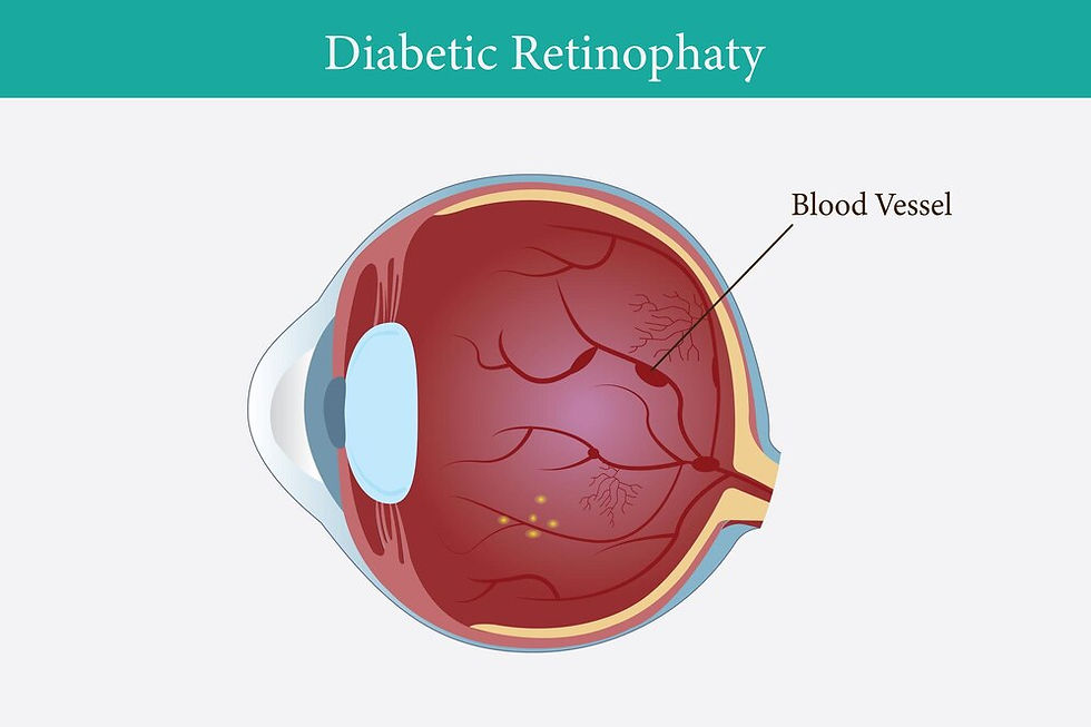 Diabetic Retinopathy