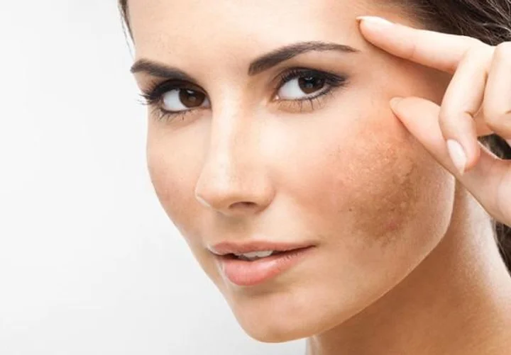 Visage-de-femme-avec-tache-pigmentee.webp
