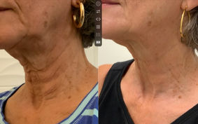 HD Radiesse Neck Injection_edited.jpg