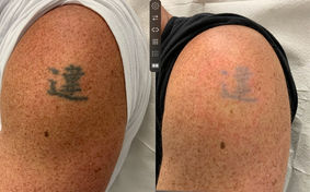 Laser Tattoo Removal (4 treatments)_edited.jpg