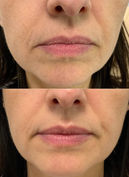 Dysport Lip Flip_edited.jpg