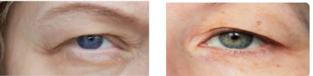 Gözkapaklarının Dış Köşeleri Kapatması