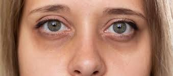 Fizyonomide göz altları nasıl yorumlanır?