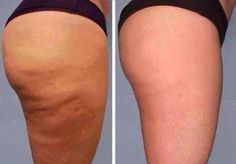 CELULITIS