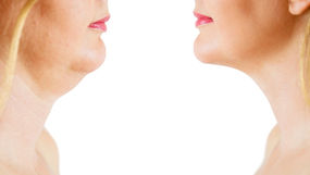 KYBELLA® - Before & After