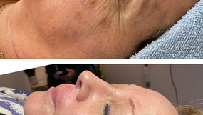 ProCell, a cutting-edge biotechnology using microchanneling with stem cells to stimulate collagen